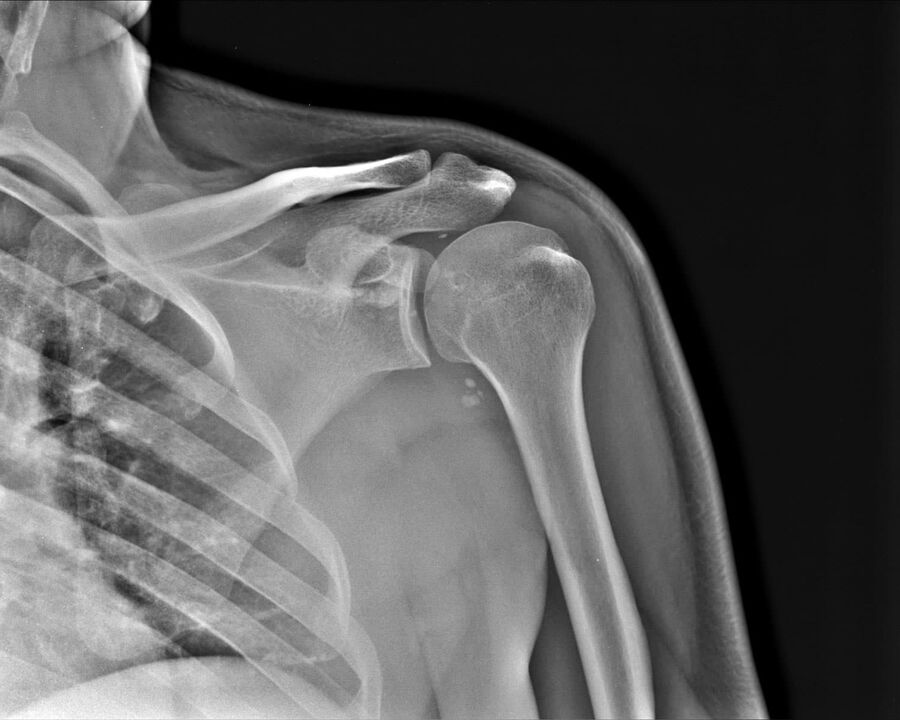 X-ray arthrosis of the shoulder joint of the 2nd degree of severity