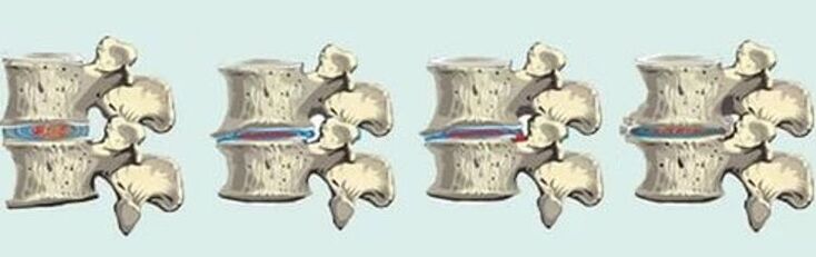 spinal lesions in cases of thoracic osteochondrosis