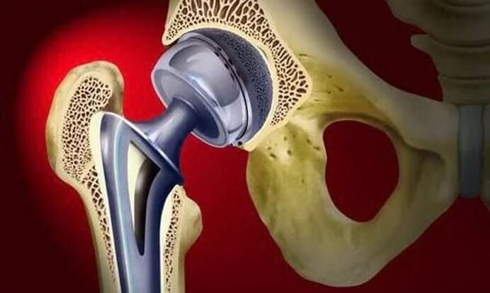 hip joint replacement for arthrosis