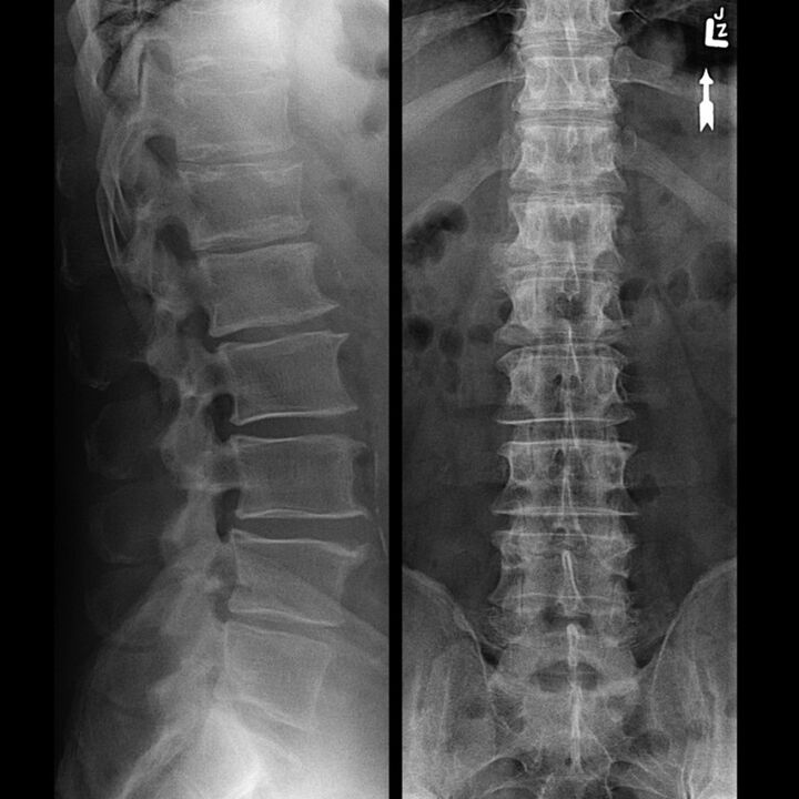 X-ray of the thoracic region, which shows a reduction in the gap between the vertebrae along the spine from bottom to top