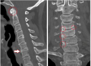 CT scans show damaged vertebrae and discs with heterogeneous height due to thoracic osteochondrosis