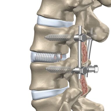 Replacement of a destroyed disc in the thoracic spine with an artificial implant