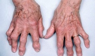 how to distinguish finger arthritis from arthrosis