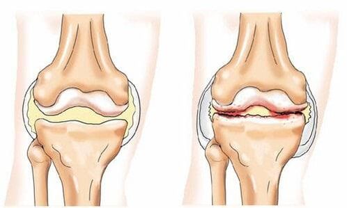 healthy knee joint and affected by arthrosis