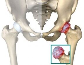 cause of osteoarthritis of the hip joint
