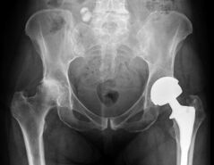 diagnosis of hip joint arthrosis