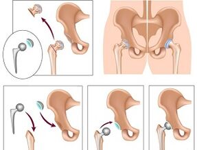 endoprosthetics for hip joint arthrosis