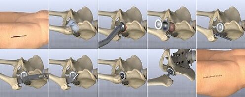 methods of treating hip arthrosis